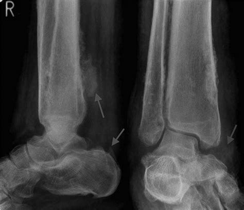 Pachydermoperiostosis: The Elephant Skin Disease | The Journal of Rheumatology