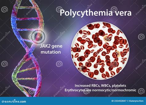 Polycythemia Vera, a Rare Slow-growing Blood Cancer with an Increase in ...