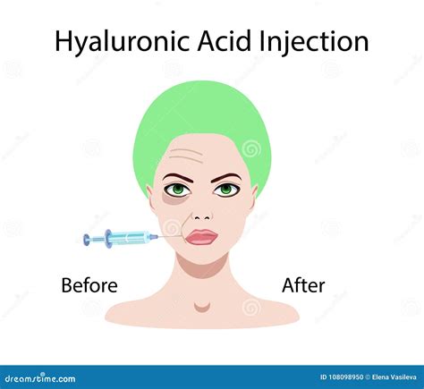 Hyaluronic Acid Injection, before and Affect , Vector Illustration ...