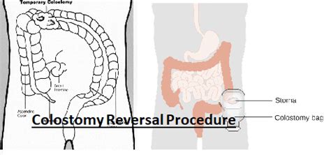 Ostomy Reversal Procedure: My Story - Patient's Lounge