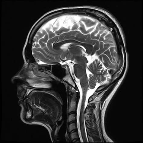 An MRI picture of my skull/brain : pics