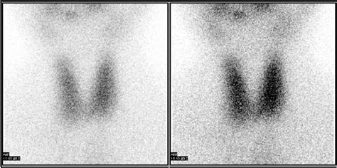 Thyroid scan showed diffuse uptake of radio iodine. | Download Scientific Diagram