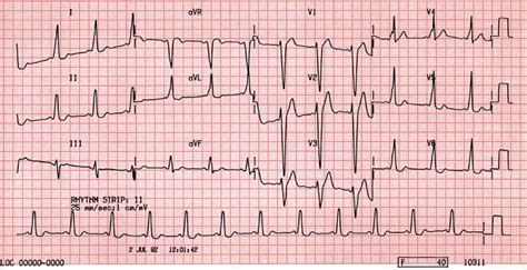 B27. Wolff Parkinson White (WPW) Syndrome Type B