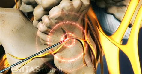 Radiofrequency Ablation (RFA) Side Effects and Risks