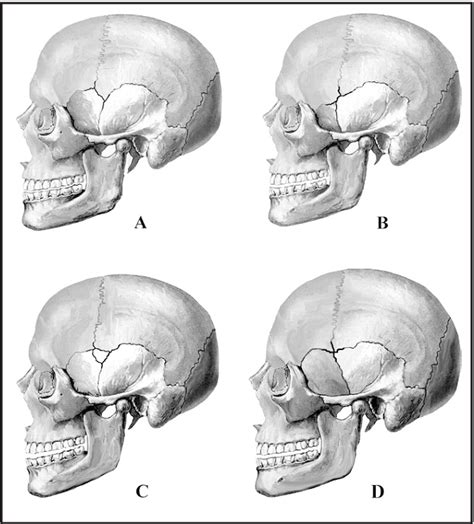 Figure 1 from Morphometric Study of Pterion in Dry Human Skull at ...