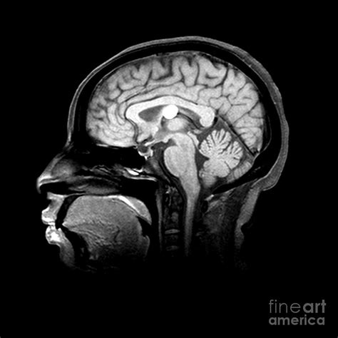 Mri Colloid Cyst Of Third Ventricle Photograph by Medical Body Scans