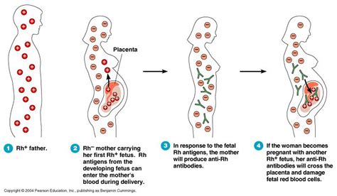 What Is The Cause Of Hemolytic Disease Of The Newborn – ScienceHUB