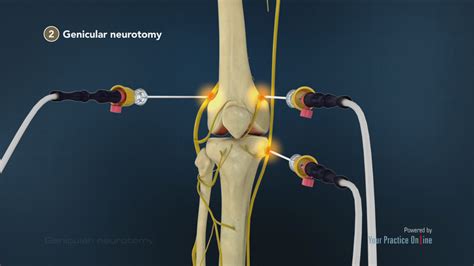 Parents Network Life: Genicular Nerve Radiofrequency Ablation