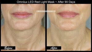 OmniLux LED Mask ~ 3 Month Results! Before & After Face, Neck, & Hand ...