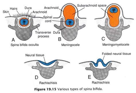 Spina Bifida Occulta A Defect In The Vertebral Arches That Is | News | Pinterest ...