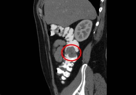 Colon polyps CT scan - wikidoc