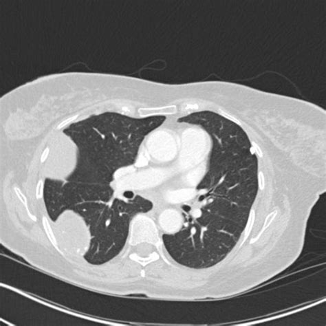 Mesothelioma Ct Scan - Example Of A Patient With Right Sided Mpm ...