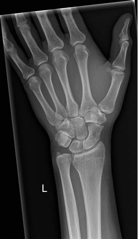 Figure Wrist X Ray With Labeled Osseous Anatomy Contributed By John ...