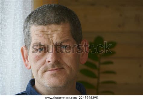 Acromegaly Face Medicine Man Skin Stock Photo 2243946395 | Shutterstock