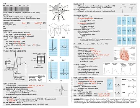 Printable 12 Lead Ekg Interpretation Cheat Sheet