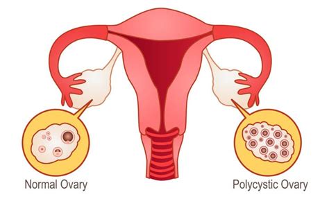 PCOS and PCOD - Homeo Clinic Chennai - Best Homeopathy Doctor in Chennai