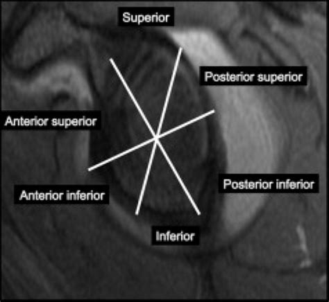 MRI of Glenohumeral Instability | Radiology Key