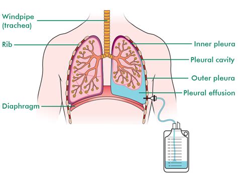 Learn About Pleural Effusion Drainage Drainage Of A Pleural Effusion ...