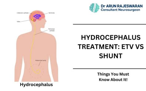 Hydrocephalus Treatment: ETV Vs Shunt