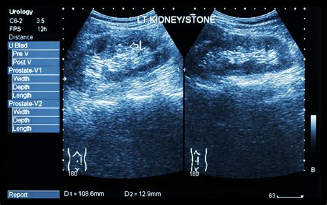 Bilateral Renal Parenchymal Disease - What EXACTLY Does It Mean?