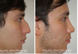 Low Bridge / Glabella Before and After Photo Gallery - Nose Surgery Photos