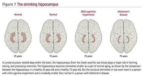 How quickly can your brain atrophy? | b-reddy.org