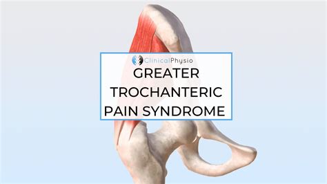 Greater Trochanteric Pain Syndrome – Clinical Physio Membership