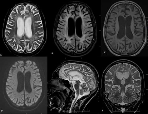 HIV Encephalopathy. 36 year male retoviral positive with abnormal... | Download Scientific Diagram