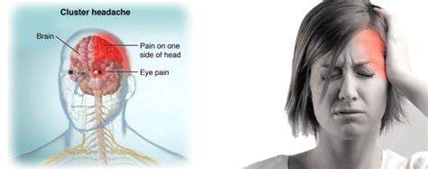 Cluster Headache - Symptoms, Causes And Other Risk Factors