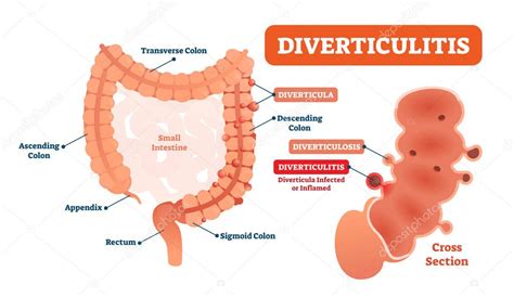 Diverticulitis vector ilustración. Diagrama etiquetado con su ...