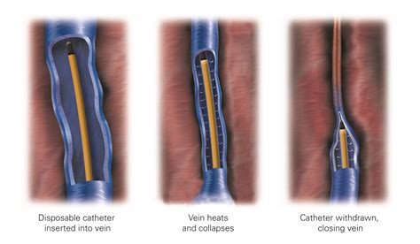 Endovenous Radiofrequency Ablation/Laser Ablation – Vascular Surgery ...