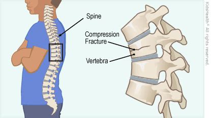 Vertebral Compression Fractures : Advanced Pain Management Center: Interventional Pain ...