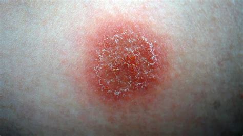 Eczema lesions: Treatment and more