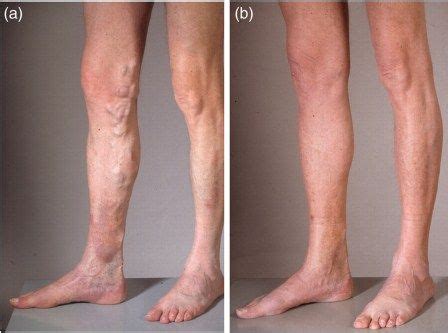 Stasis dermatitis – Causes, Symptoms, Diagnosis, Treatment and Ongoing care - Chronic ...