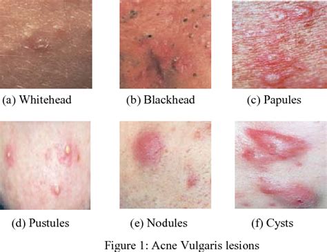 Figure 1 from Identification of acne lesions, scars and normal skin for acne vulgaris cases ...