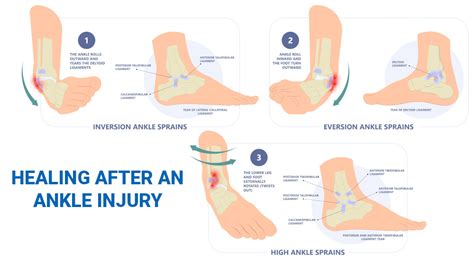 Swollen Ankle Sprain - vrogue.co