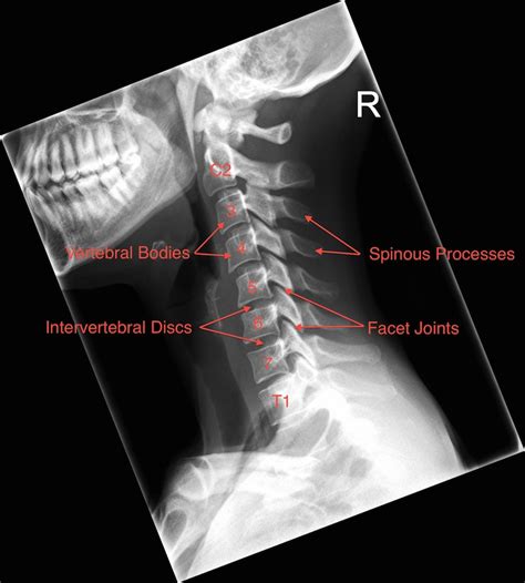 check out my Xrays and tell me what you think - General Discussion - DOOTalk Forums