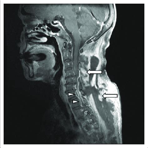 Spinal Lesions On MRI