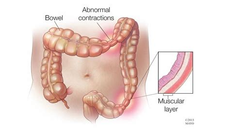 Coping With Irritable Bowel Syndrome (IBS) | Doctors Without Waiting Rooms