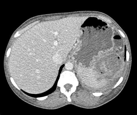 Splenic Abscess - Spleen Case Studies - CTisus CT Scanning