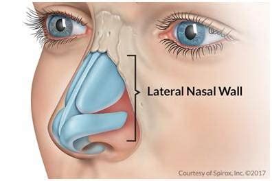 Spirox Nasal Implant - Richard Weinstock DO