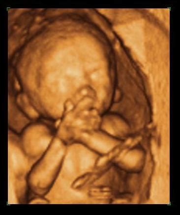 Mid Trimester Anatomy Scan - Specialists in Pregnancy Ultrasounds and ...