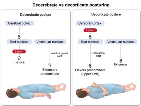 Decorticate vs Decerebrate posturing