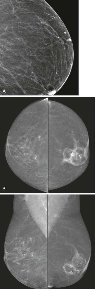 Calcifications Made Easy | Radiology Key