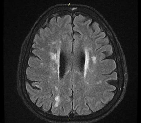 Periventricular white matter hyperintensities and deep white matter ...