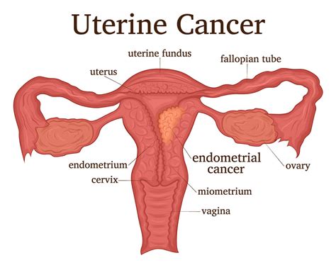 Uterine Cancer Treatment | The Center for Gynecologic Oncology