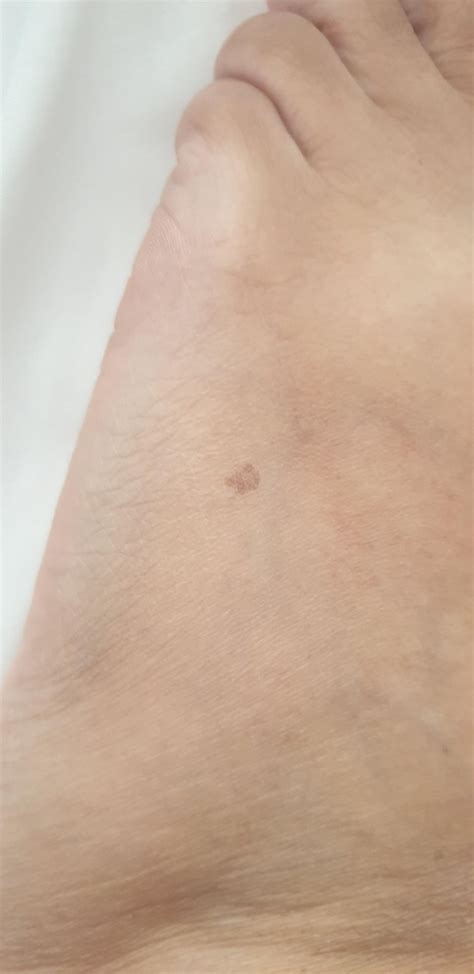 10 days post shave biopsy. Is this healing right? : r/Melanoma