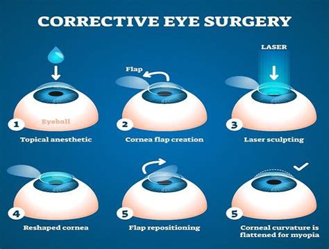 What is LASIK Surgery? Know its cost & Treatment