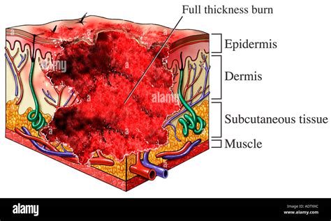 Third Degree Burn: Full Thickness Burn Stock Photo - Alamy