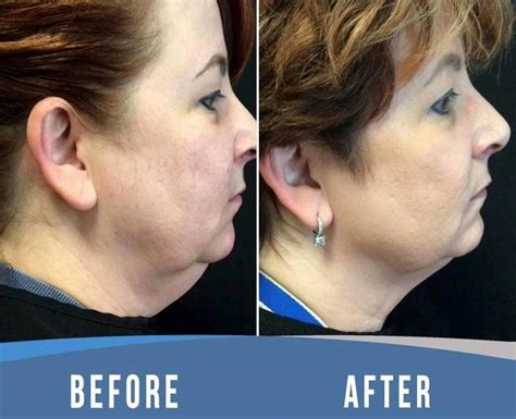 Thermage For Neck Before And After (5) » Facelift: Info, Prices, Photos, Reviews, Q&A